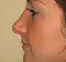 Nose Surgery