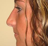 Nose Surgery