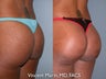 Buttock Implants