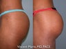 Buttock Implants