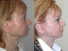 SLUPlift minifacelift