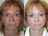 SLUPlift minifacelift