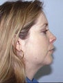 Before and After Chin Implant with Liposuction (Side View)
