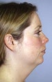 Before and After Chin Implant with Liposuction (Side View)