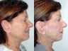 SLUPlift (Mini-lift procedure)