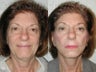 SLUPlift (Mini-lift procedure)