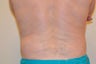 CoolSculpting Results