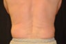 CoolSculpting Results
