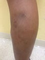 61 yo female with varicose veins treated by laser ablation.