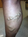 61 yo female with varicose veins treated by laser ablation.
