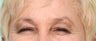 Glabellar Lines - 63 year old female