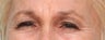 Glabellar Lines - 63 year old female