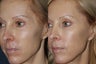 Before & After Fraxel