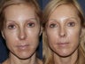 Before & After Fraxel