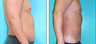Liposuction Before & After