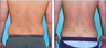 Liposuction Before & After