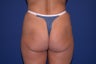 51 Year Old Patient Treated for Buttock Drooping & Flatness