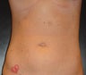 SmartLipo MPX