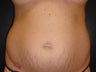 SmartLipo MPX