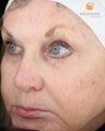 Female treated with 3 Photodynamic Therapy with Levulan for Pre-Skin Cancer (AK's)