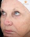 Female treated with 3 Photodynamic Therapy with Levulan for Pre-Skin Cancer (AK's)