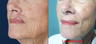 65-year-old with poor lip scarring repaired with local flap reconstruction