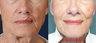 65-year-old with poor lip scarring repaired with local flap reconstruction