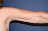 Arm Lift