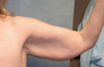 Arm Lift