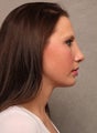 Chin Implant