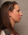 Chin Implant