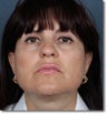 Face & Neck Lift