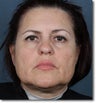 Face & Neck Lift