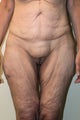 Tummy Tuck/Body Lift