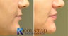 Lip Augmentation