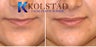 Lip Augmentation