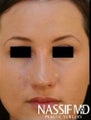 Female Primary Rhinoplasty