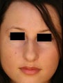 Female Primary Rhinoplasty
