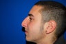 Rhinoplasty
