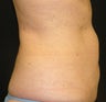 CoolSculpting