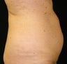 CoolSculpting