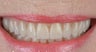 Porcelain veneers for tooth grinders