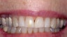 Porcelain veneers for tooth grinders