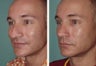 Male Revision Rhinoplasty