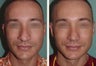 Male Revision Rhinoplasty