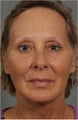 62 year old female with loss of facial volume contributing to sagging along her neck and jaw line