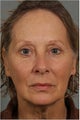 62 year old female with loss of facial volume contributing to sagging along her neck and jaw line
