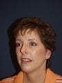Female with Chin Implant, Eyelid Surgery and SignatureLift