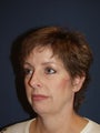 Female with Chin Implant, Eyelid Surgery and SignatureLift