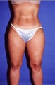 32 Year Old Female Treated with Smart Lipo